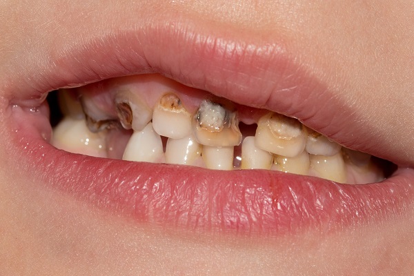 שיניים 3